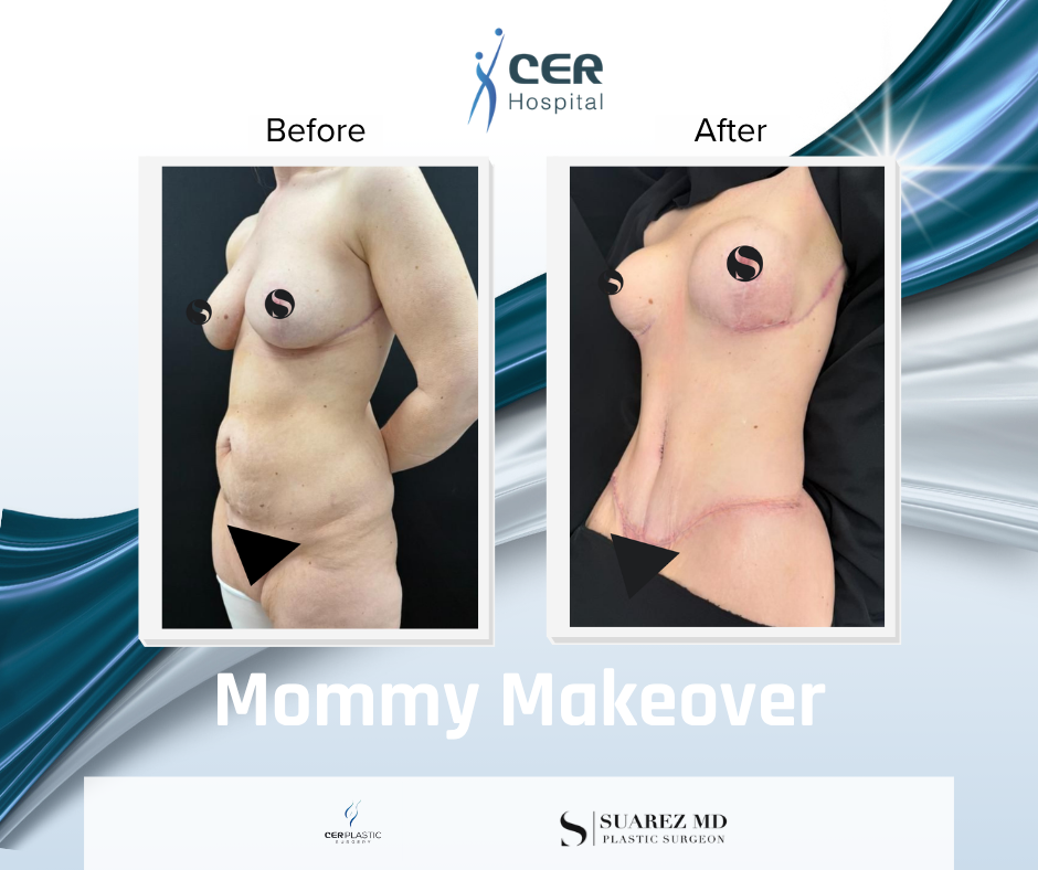 Mommy Makeover - 190326 - Image 3
