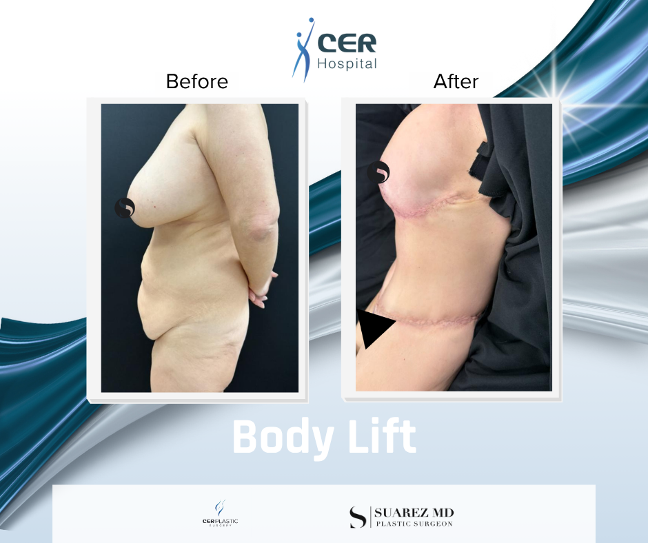 Body Lift - 020326 - Image 4