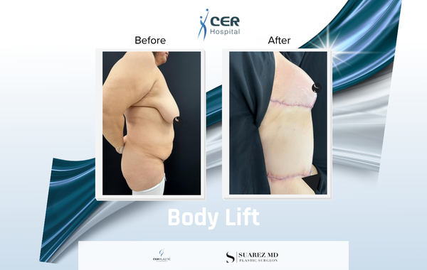 Body Lift - 170326 - Image 6