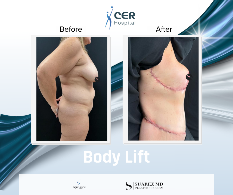 Body Lift - 090326 - Image 4