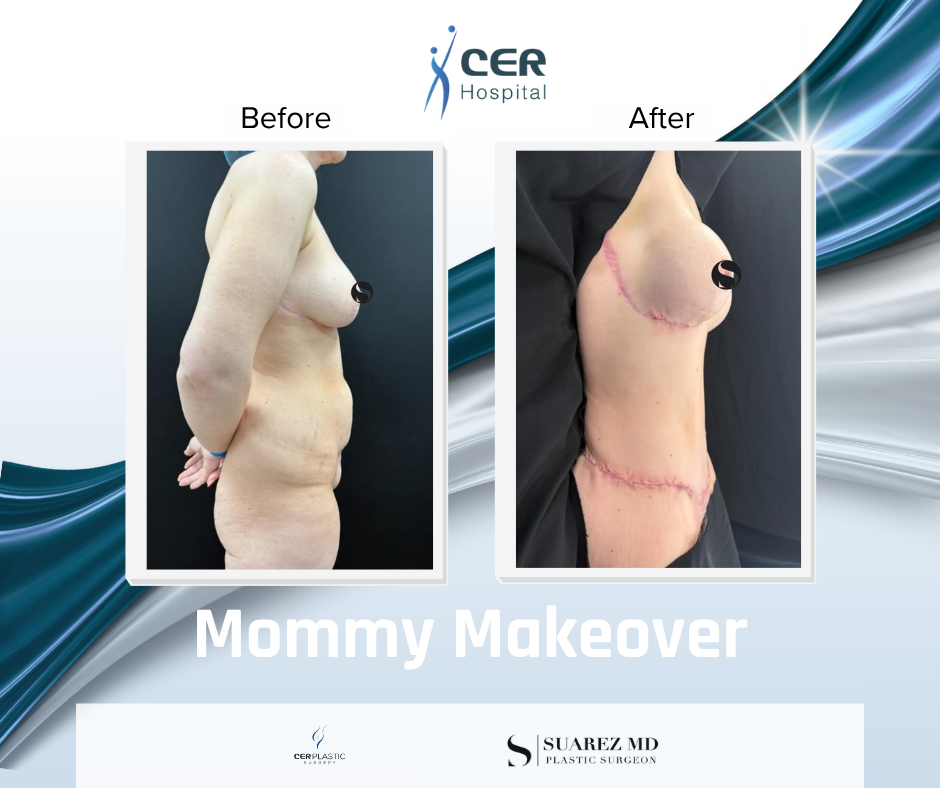 Mommy Makeover - 190326 - Image 4