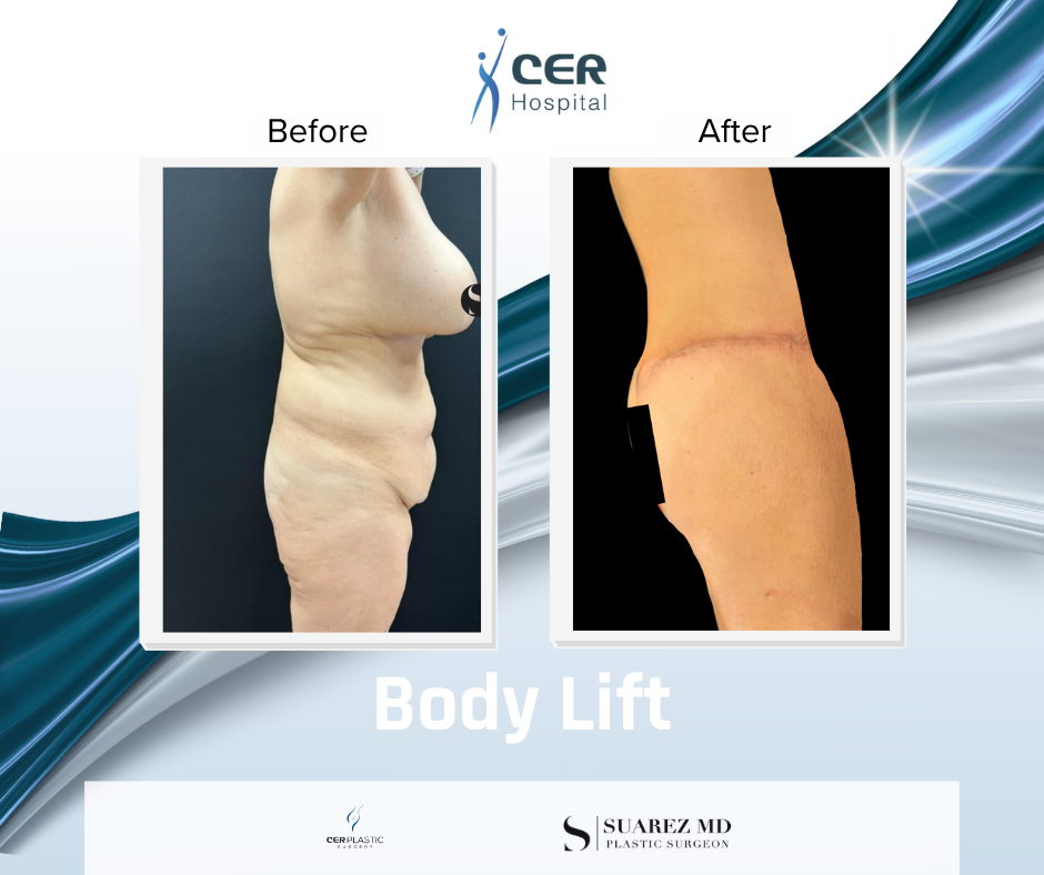 Body Lift - 020326 - Image 5