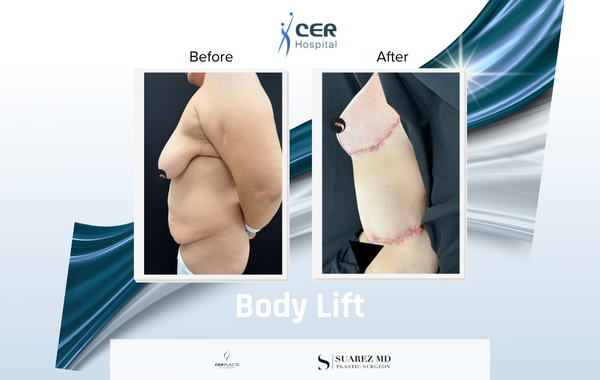 Body Lift - 170326 - Image 7
