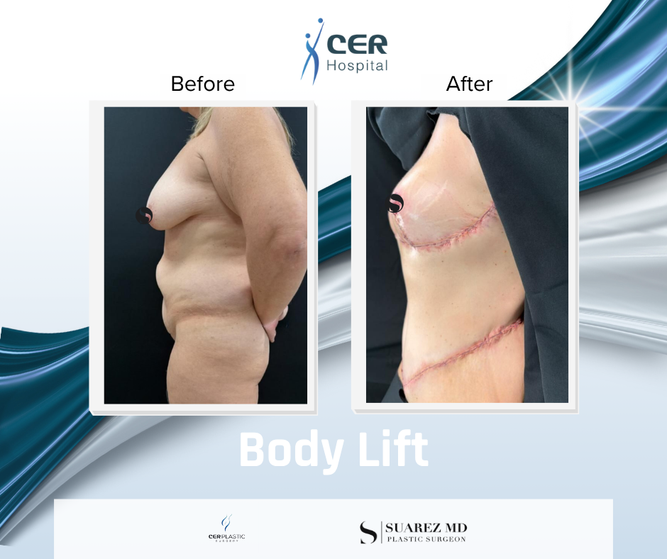 Body Lift - 090326 - Image 5