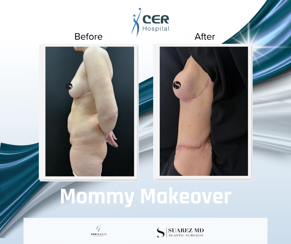 Mommy Makeover - 190326 - Image 5