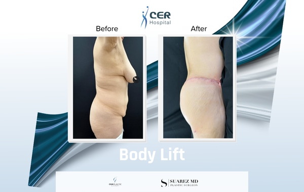Body Lift - 170326 - Image 8