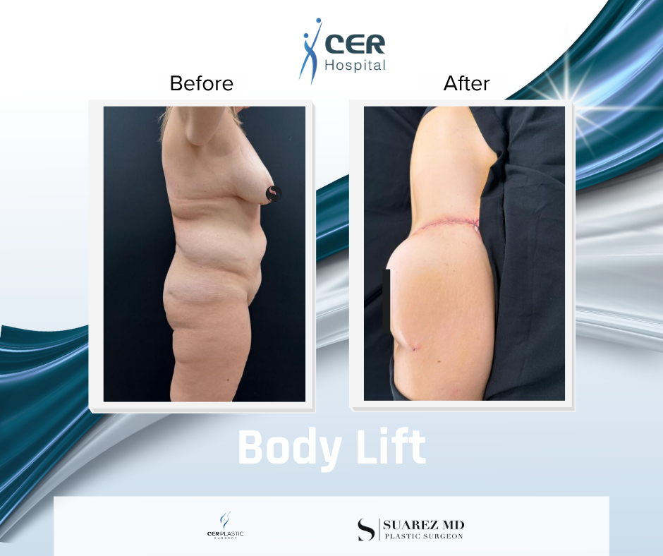 Body Lift - 090326 - Image 6