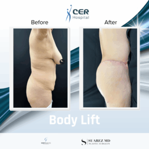 Body Lift – 170326