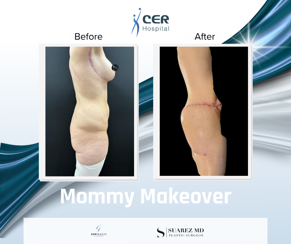 Mommy Makeover - 190326 - Image 6