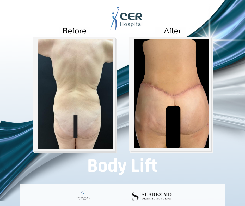 Body Lift - 020326 - Image 6
