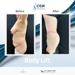 Body Lift – 170326