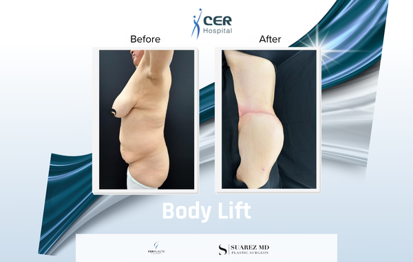 Body Lift - 170326