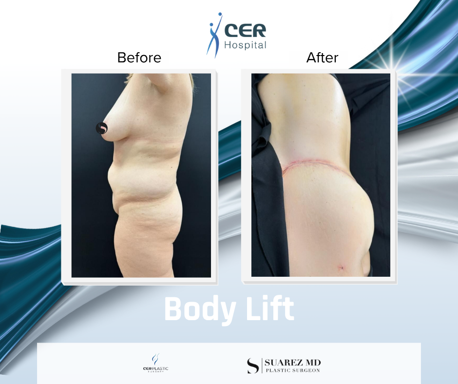 Body Lift - 090326 - Image 7