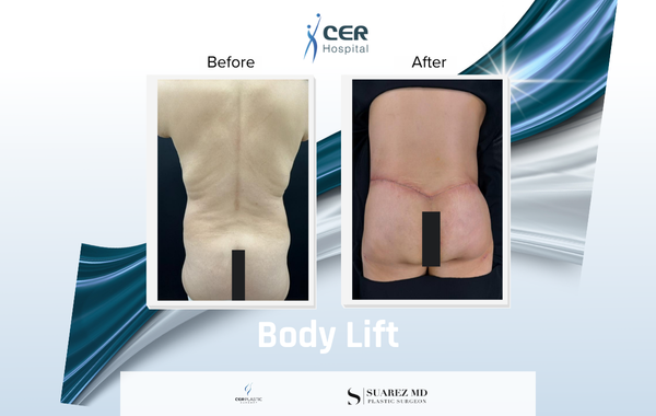 Body Lift - 170326 - Image 9