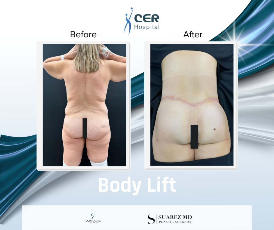Body Lift - 090326 - Image 8