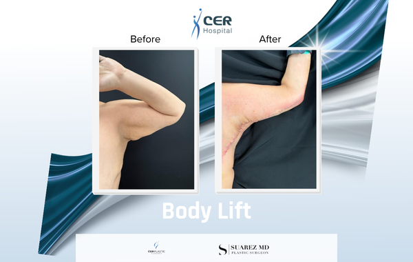 Body Lift - 170326 - Image 10