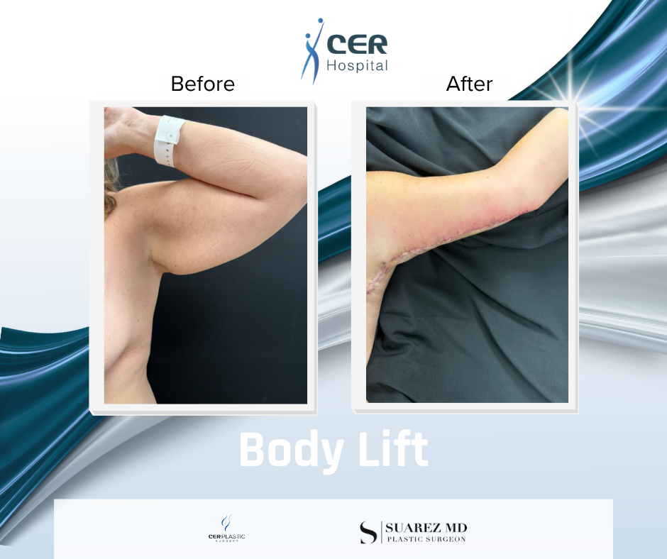 Body Lift - 090326 - Image 9