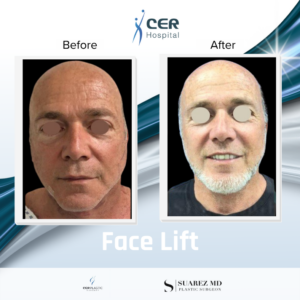 Face Lift – 17262