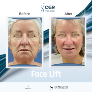 Face Lift – 17263