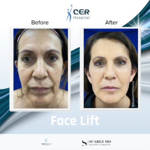 Face Lift – 17264