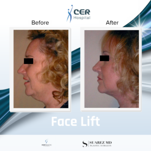 Face Lift – 17261