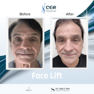 Face Lift – 17265