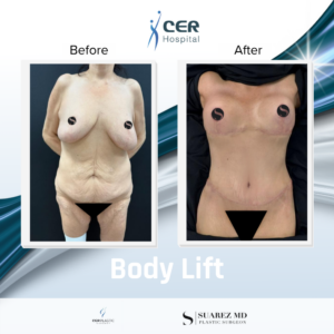 Body Lift – 030426