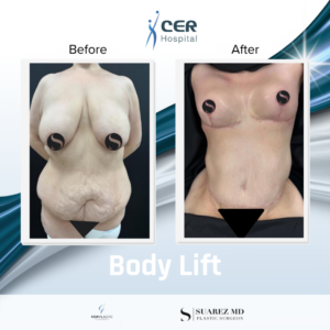 Body Lift – 100426