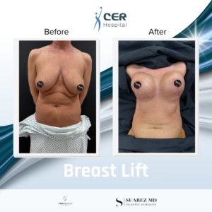 Breast Lift – 130426