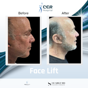 Face Lift – 17262