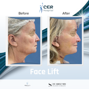 Face Lift – 17263
