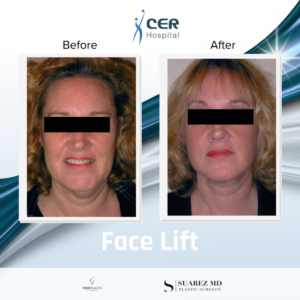 Face Lift – 17261