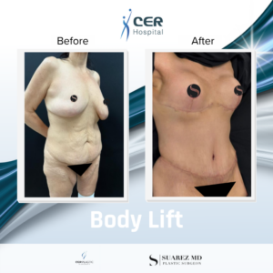 Body Lift – 030426