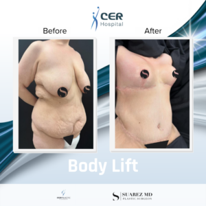 Body Lift – 100426