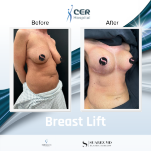 Breast Lift – 130426