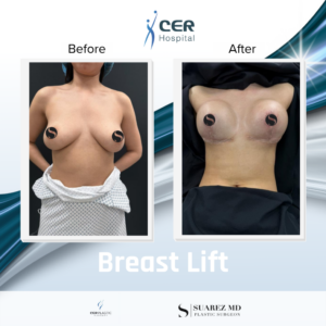 Breast Lift - 180526