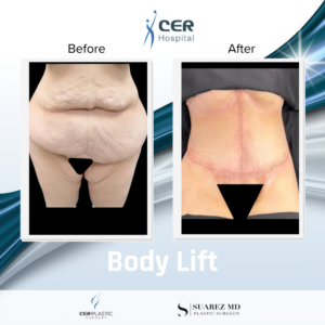 Body Lift – 060426