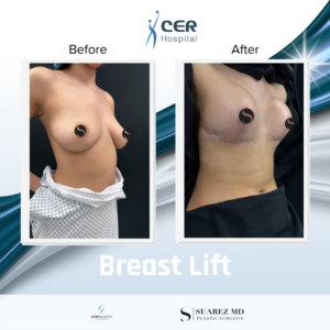 Breast Lift – 180526