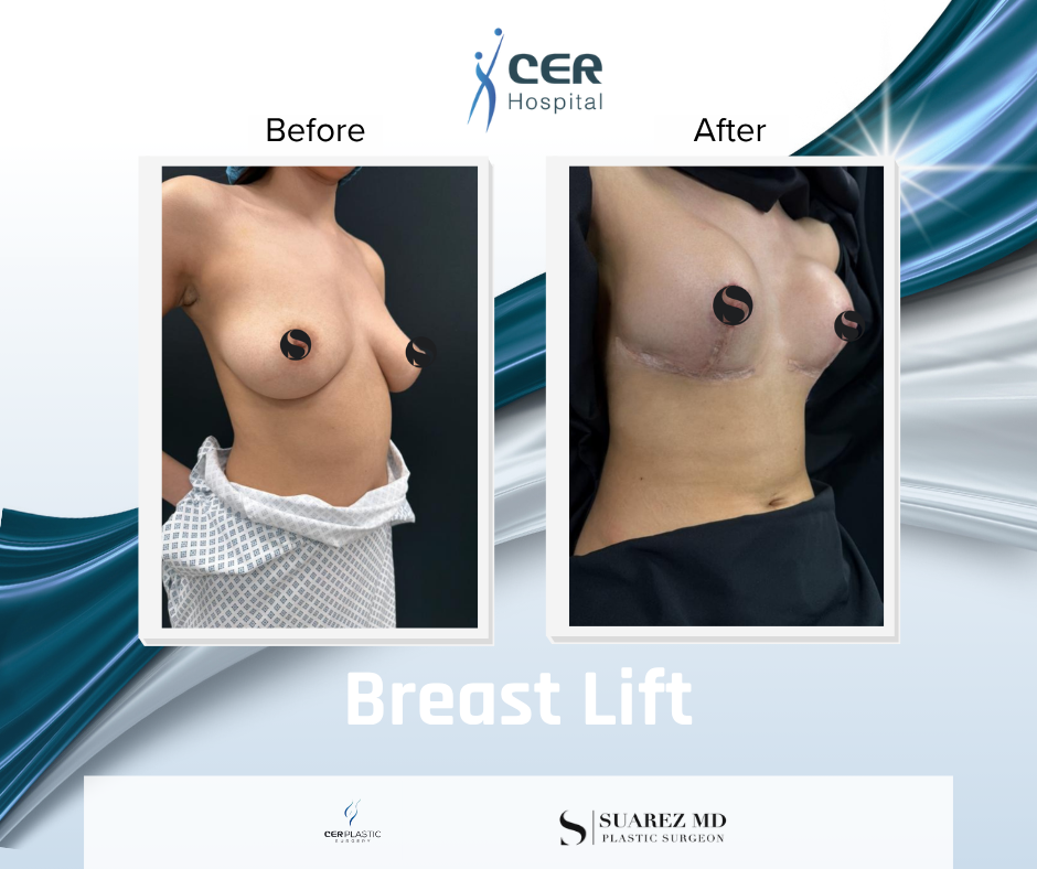 Breast Lift - 180526 - Image 2
