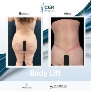 Body Lift - 060426