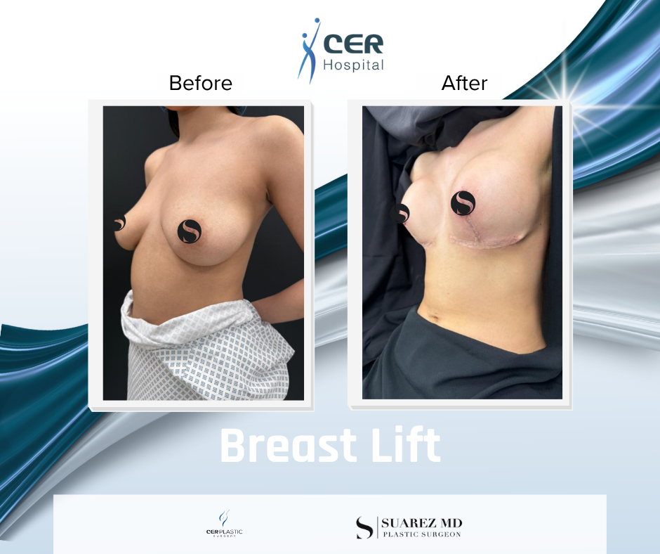Breast Lift - 180526 - Image 3
