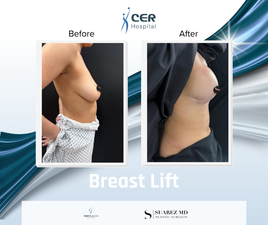 Breast Lift - 180526 - Image 4