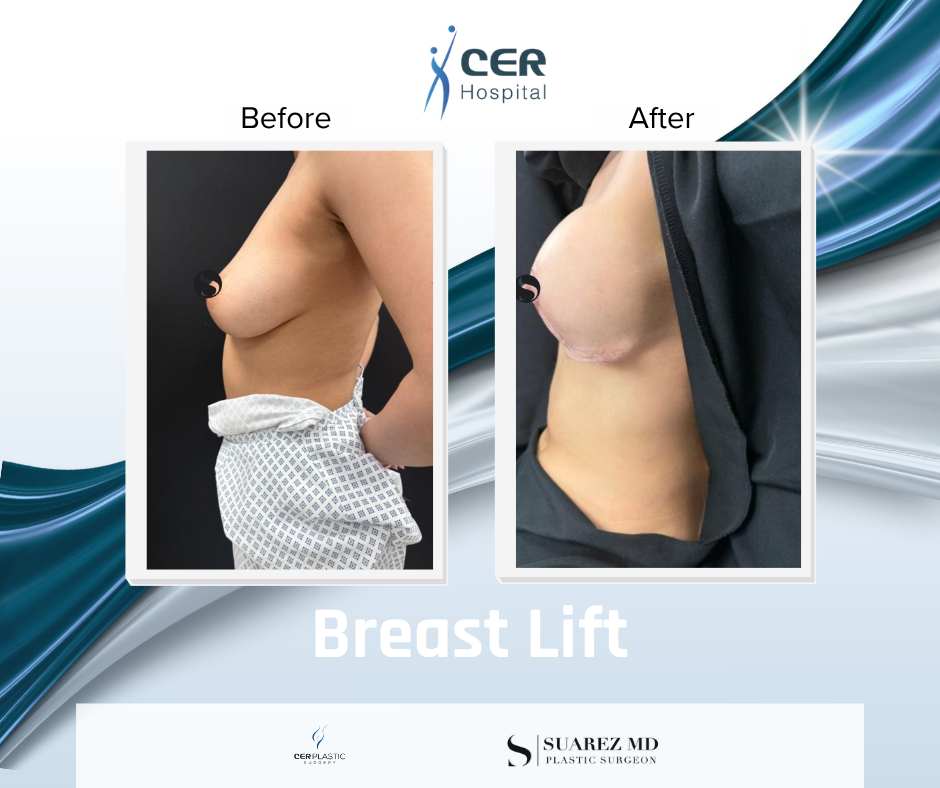 Breast Lift - 180526 - Image 5