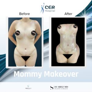 Mommy Makeover – 140723