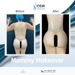 Mommy Makeover – 140723