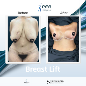 Breast Lift – 090626