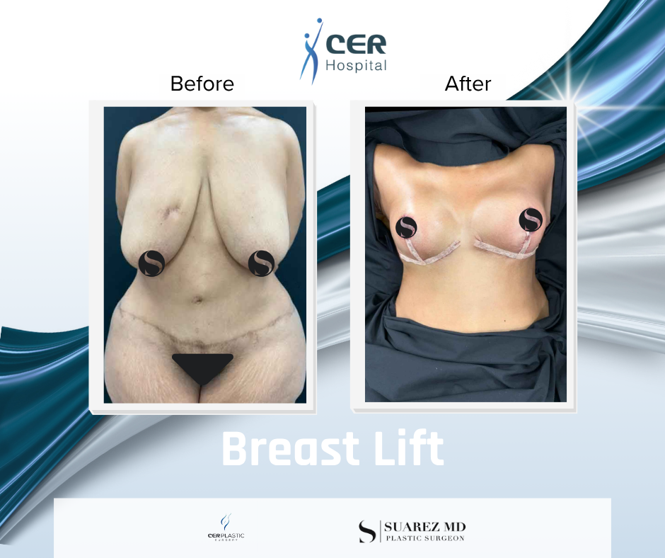 Breast Lift - 090626