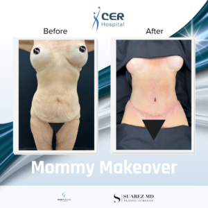 mommy makeover – 110626