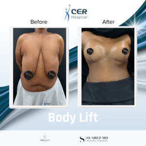 Body Lift – 040626