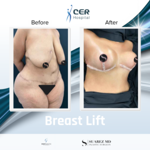 Breast Lift – 090626